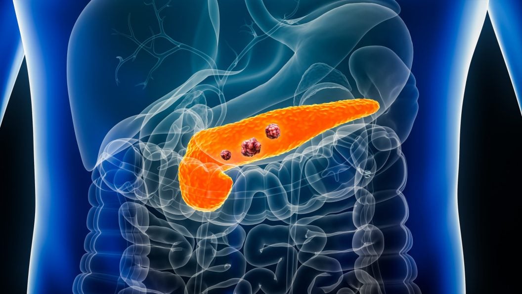 A 3D image of the inside of a human torso with the pancreas lit up in orange