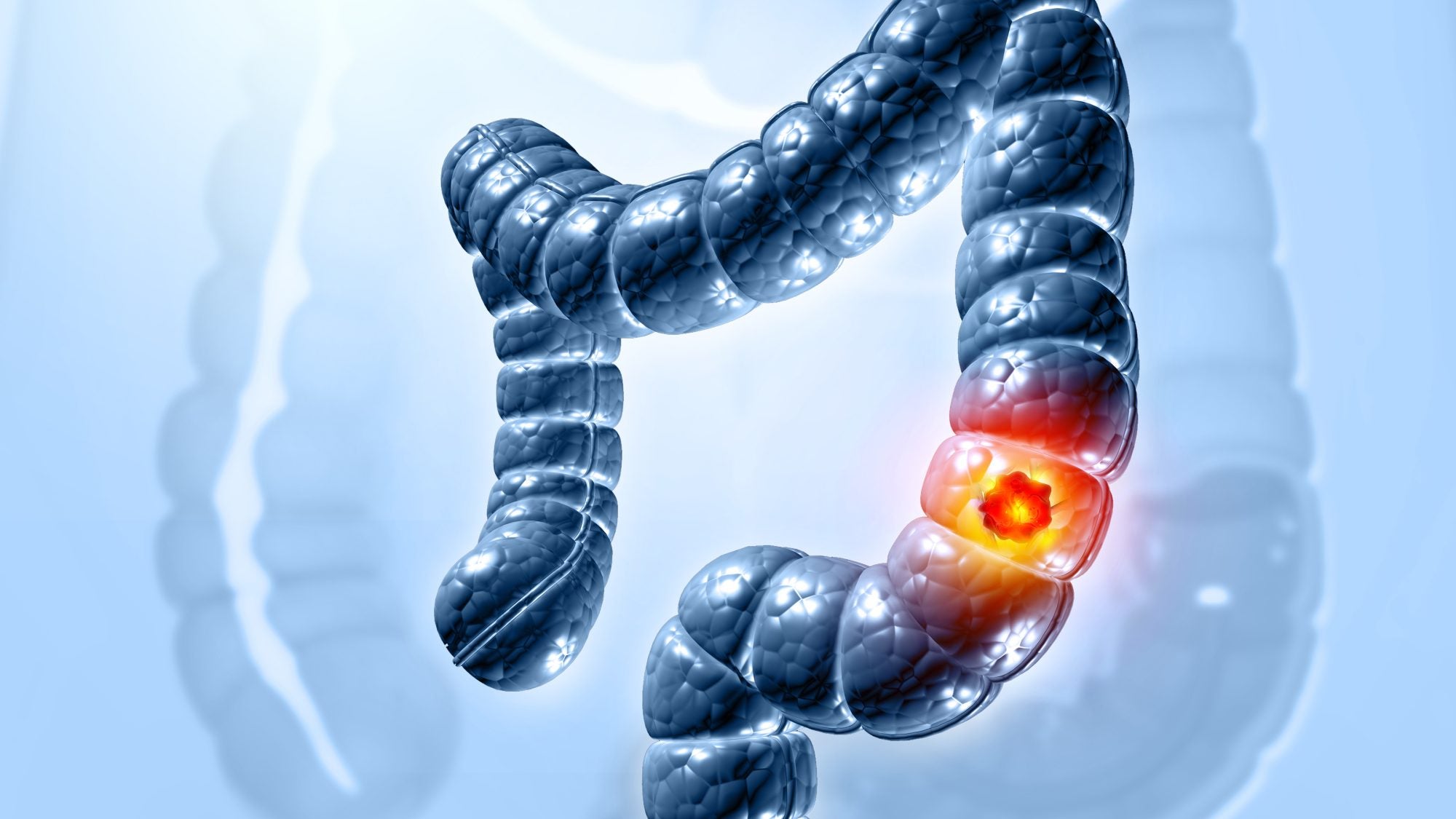 Colon cancer. Cancer attacking cell. Colon disease concept. 3d illustration