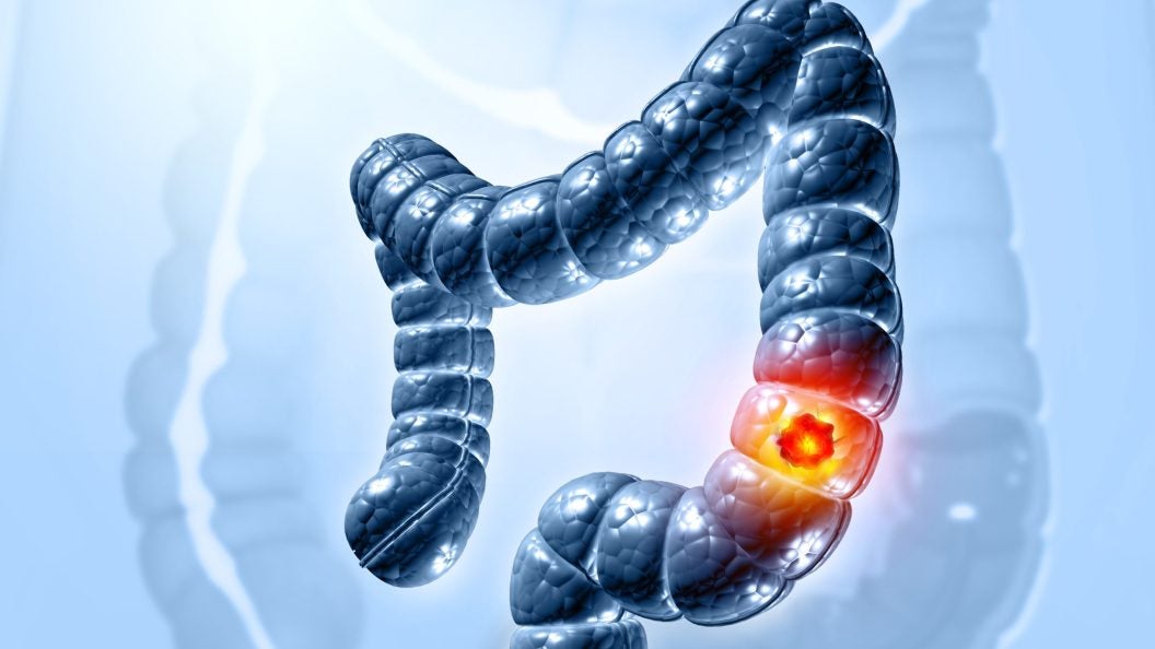 Colon cancer. Cancer attacking cell. Colon disease concept. 3d illustration