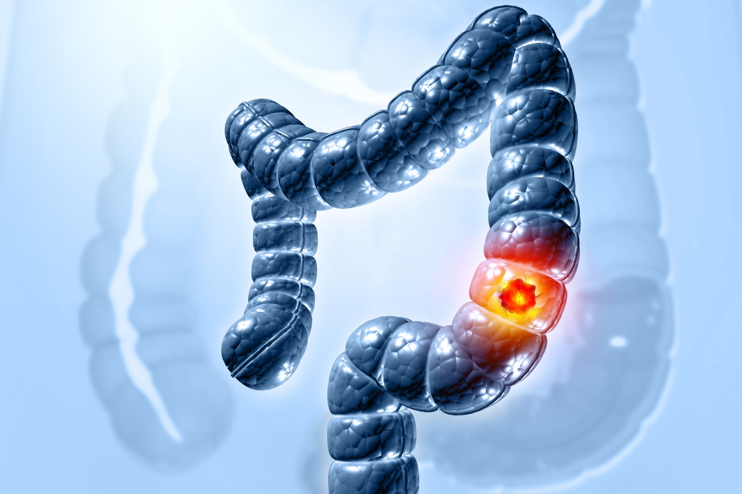 Young-Onset Colorectal Cancer Rates Rising: Trends and Research