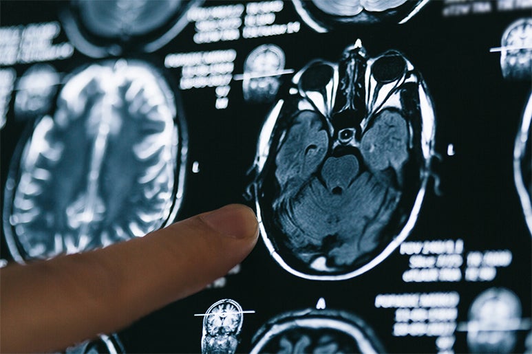 A finger points to X-ray images of the brain.