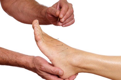 A photo of hands putting acupuncture needles into a foot.